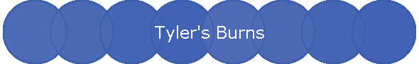 Tyler's Burns